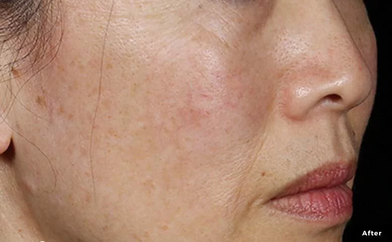 https://api.dermapro.me/images/1920x744xi/1enlighten-Stankiewicz-MD-After.webp