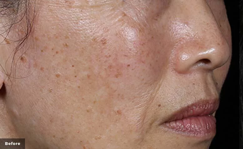 https://api.dermapro.me/images/1920x744xi/1enlighten-Stankiewicz-MD-Before.webp