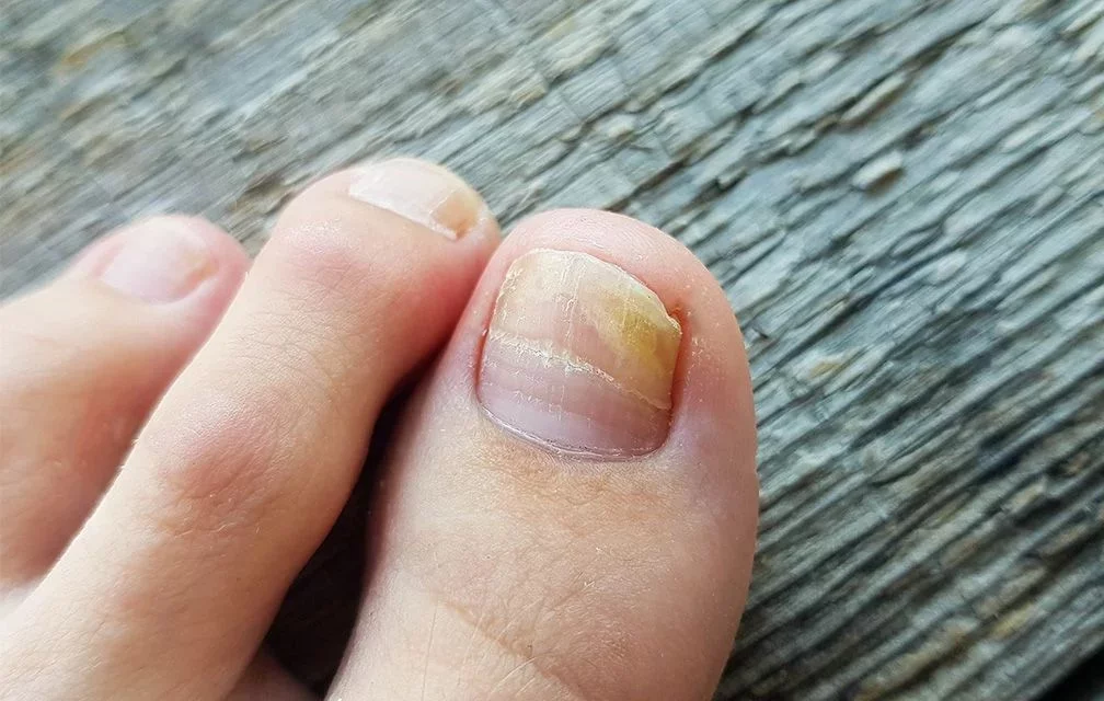 Toenail Fungus Infection Symptoms