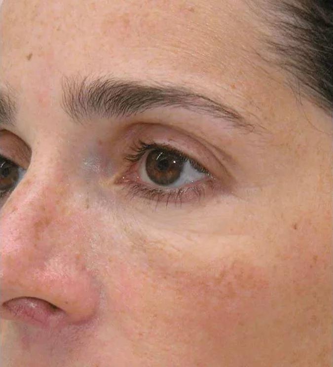 https://api.dermapro.me/images/1920x744xi/Mesotherapy-after.webp