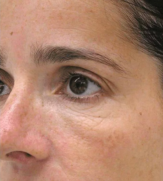 https://api.dermapro.me/images/1920x744xi/Mesotherapy-before.webp