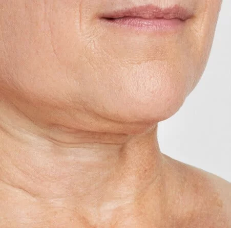 https://api.dermapro.me/images/1920x744xi/blinder-debbie-neck-after-601.webp