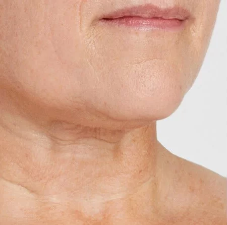 https://api.dermapro.me/images/1920x744xi/blinder-debbie-neck-after-602.webp