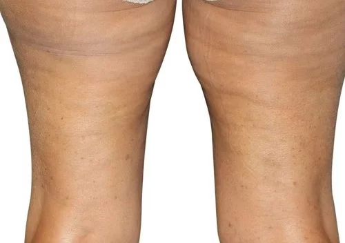 https://api.dermapro.me/images/1920x744xi/cellulite_2_after.webp