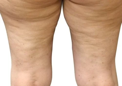 https://api.dermapro.me/images/1920x744xi/cellulite_2_before.webp