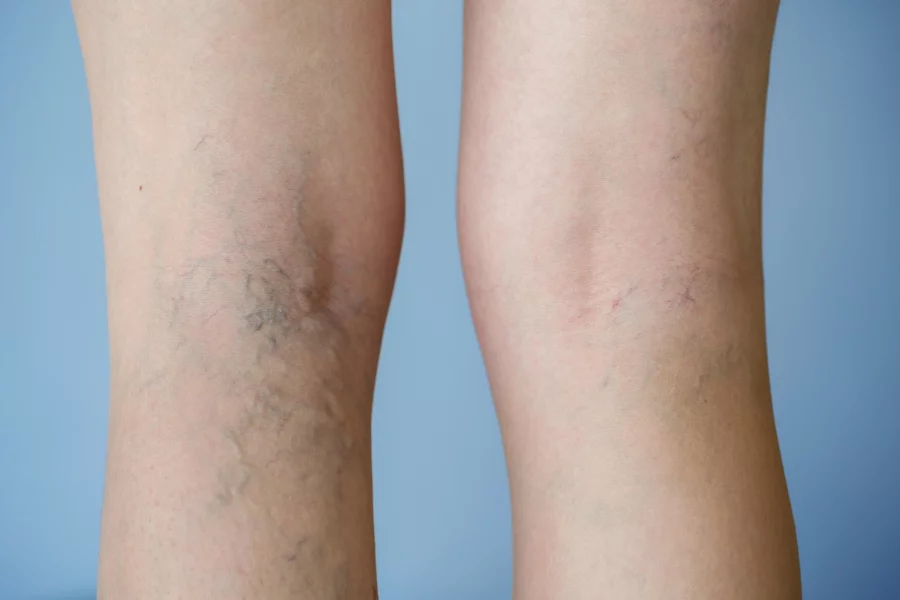 How long after sclerotherapy do veins disappear?