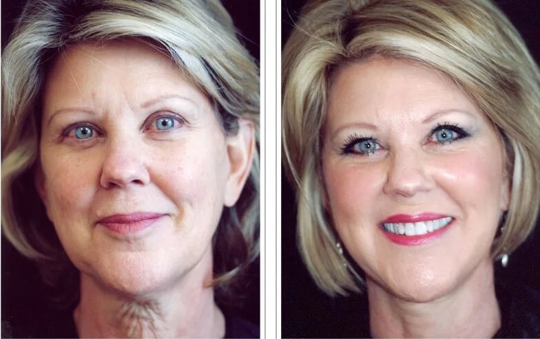 Learn More: HIFU or FaceLift?