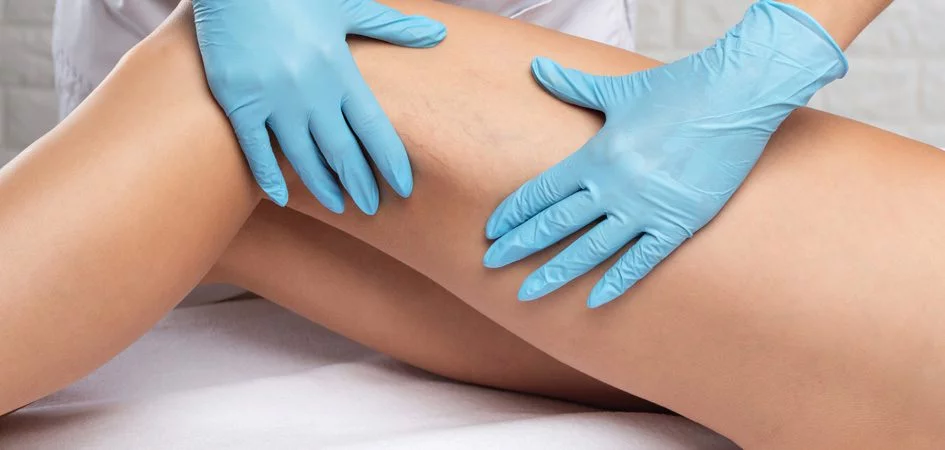 How many Sclerotherapy treatment sessions are required?