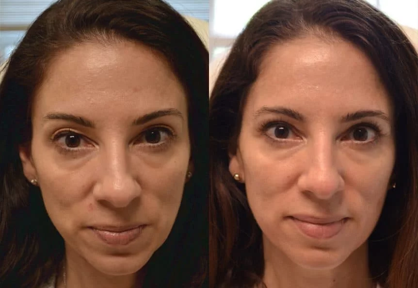 Blepharoplasty